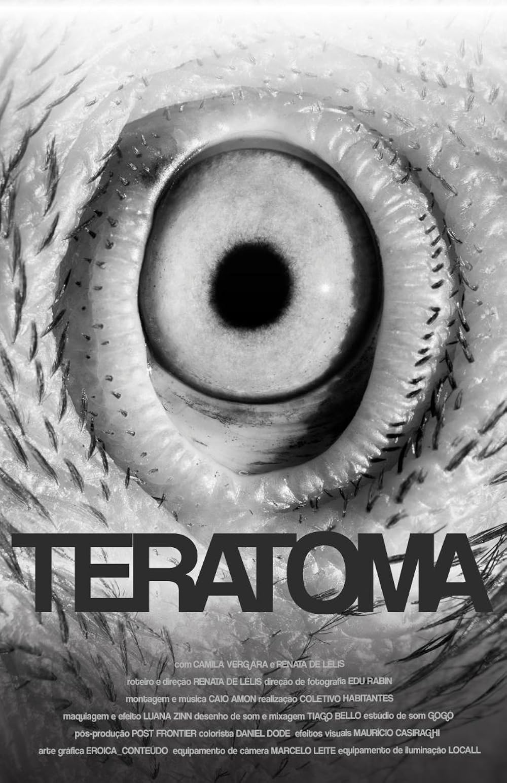 Teratoma